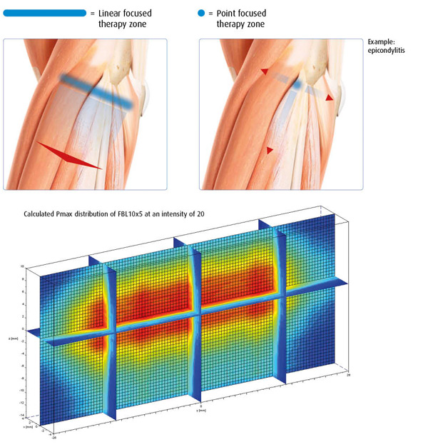 ESWT-máquina de terapia de ondas de choque electromagnéticas